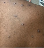 Example of Monkeypox Rash
